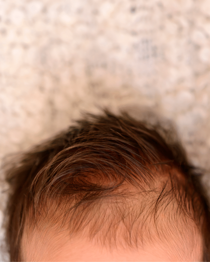 Baby hair loss